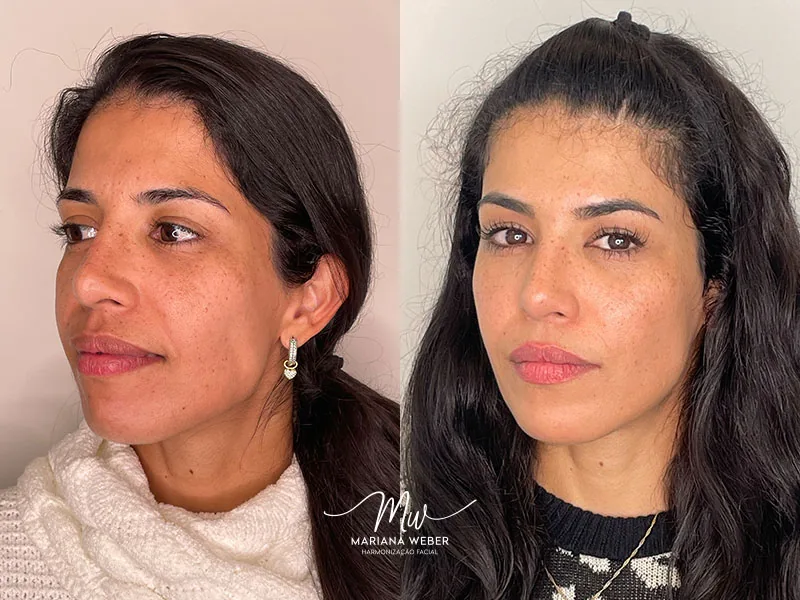 Antes e depois — viço da pele da Márcia T. após retomar consistência